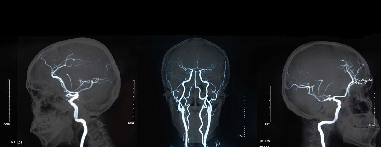 سونوگرافی عروق مغز