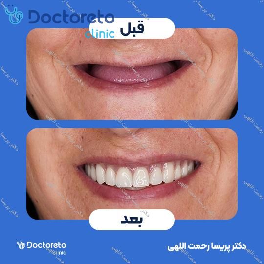 جرم گیری دو فک با بروساژ زیر لثه