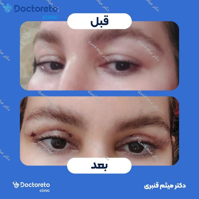 بلفاروپلاستی به روش جراحی