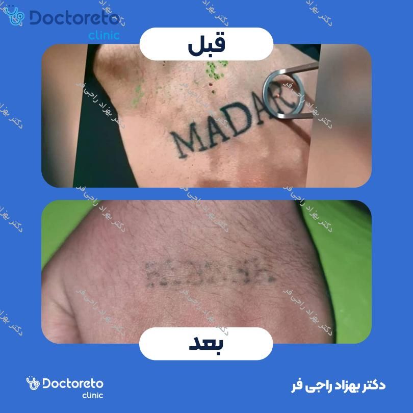 پاک کردن تاتو بدن با دستگاه کیوسوئیچ (هر سانتی متر)