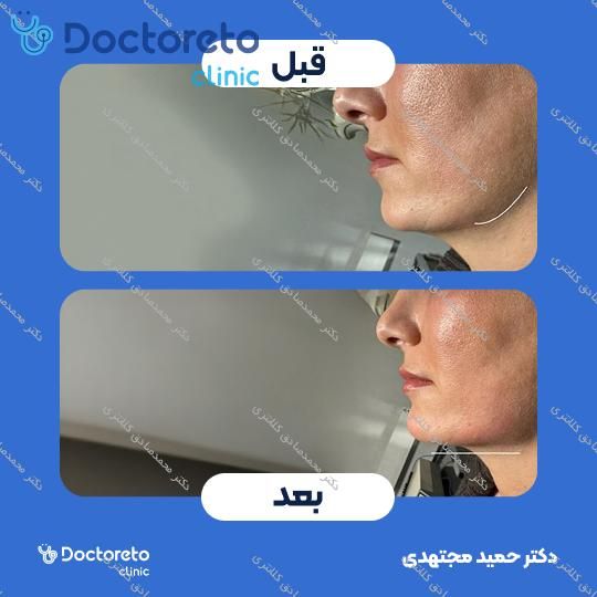 تزریق ژل زاویه فک