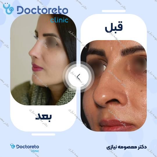 عمل جراحی زیبایی بینی استخوانی (رینوپلاستی)