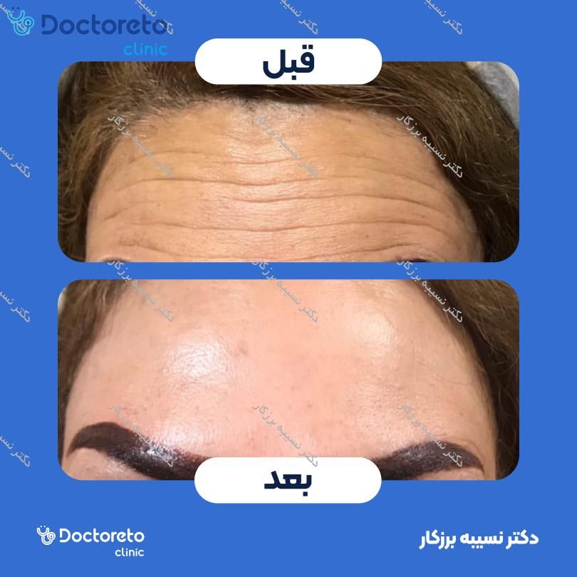 تزریق بوتاکس صورت (پیشانی، خط اخم، پنجه کلاغی)💉
