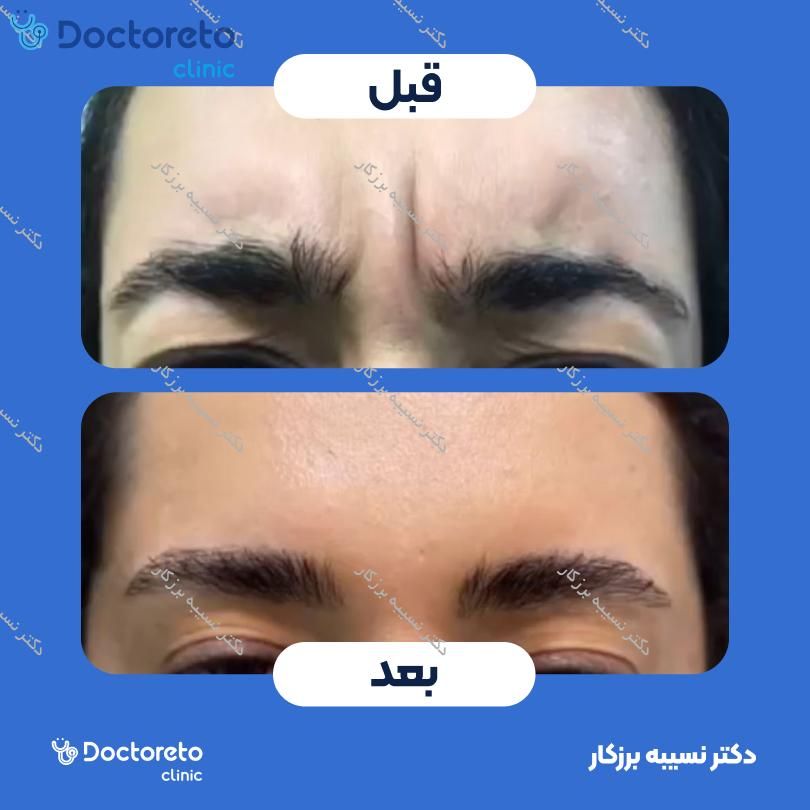 تزریق بوتاکس صورت (پیشانی، خط اخم، پنجه کلاغی)💉