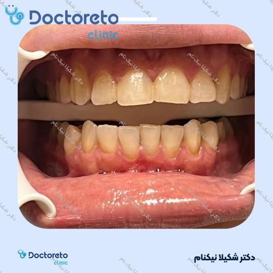 بلیچینگ دندان (سفید کردن دندان)