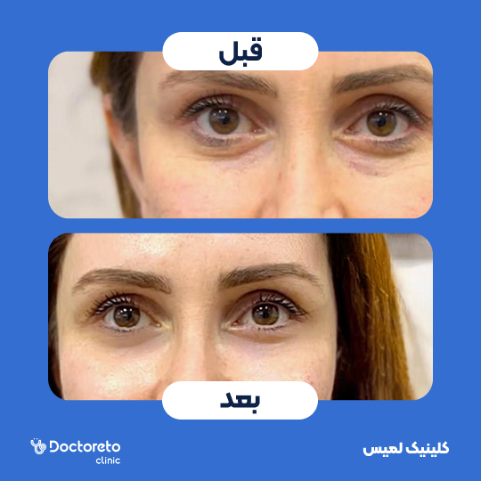 تزریق ژل زیرچشم