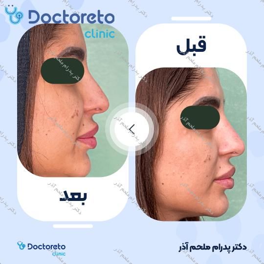 تزریق ژل بینی