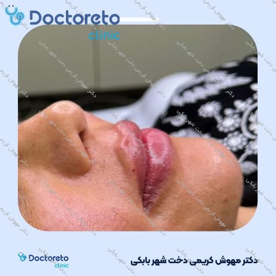 تزریق ژل لب