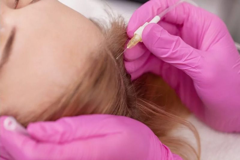 درمان ریزش مو به روش پلاسماتراپی (هرجلسه)