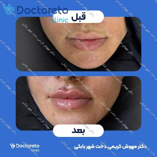 تزریق ژل لب