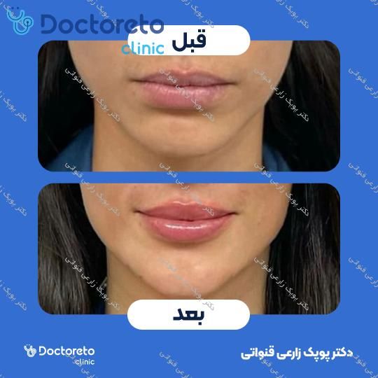 تزریق ژل چانه