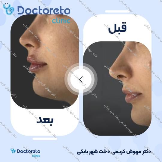 تزریق ژل لب