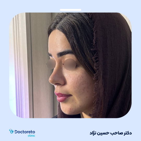 عمل زیبایی بینی استخوانی (رینوپلاستی)