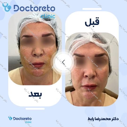 لیفت صورت با نخ (هر عدد)