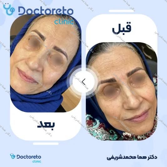 جوانسازی صورت با پلاسما تراپی (هرجلسه)