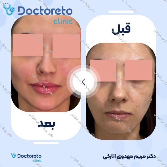 تزریق ژل چانه