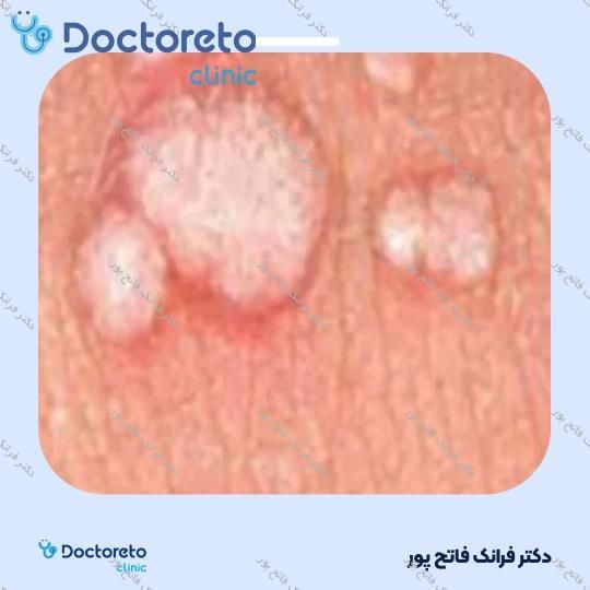 برداشتن زگیل تناسلی بانوان (هر عدد)