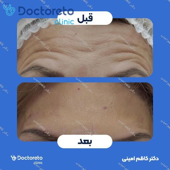 تزریق بوتاکس صورت (پیشانی، خط اخم، پنجه کلاغی)💉