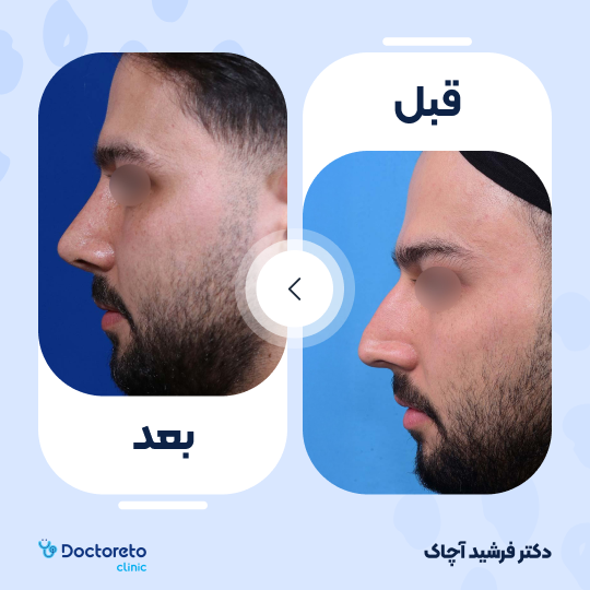 عمل جراحی ترمیمی زیبایی بینی (رینوپلاستی)