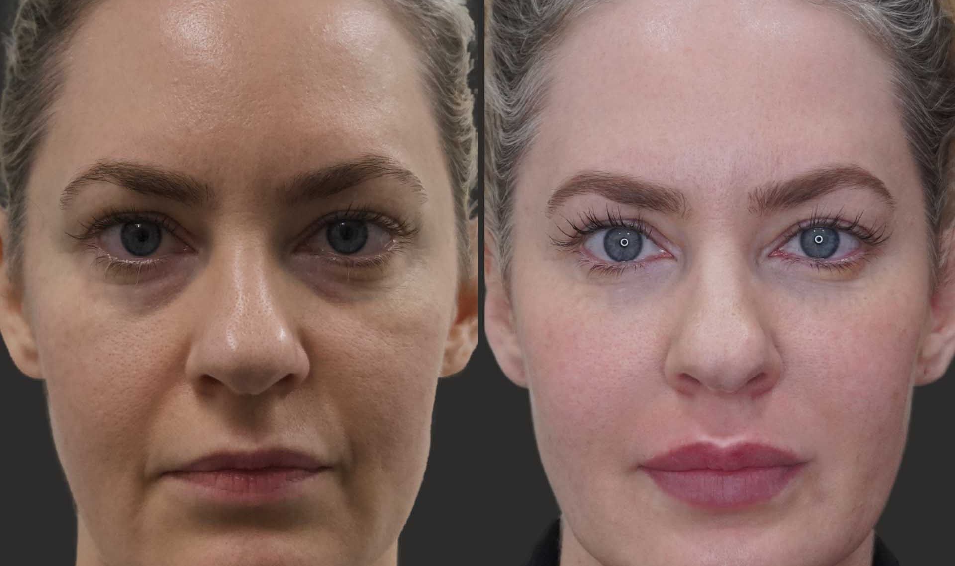 تزریق ژل زیر چشم