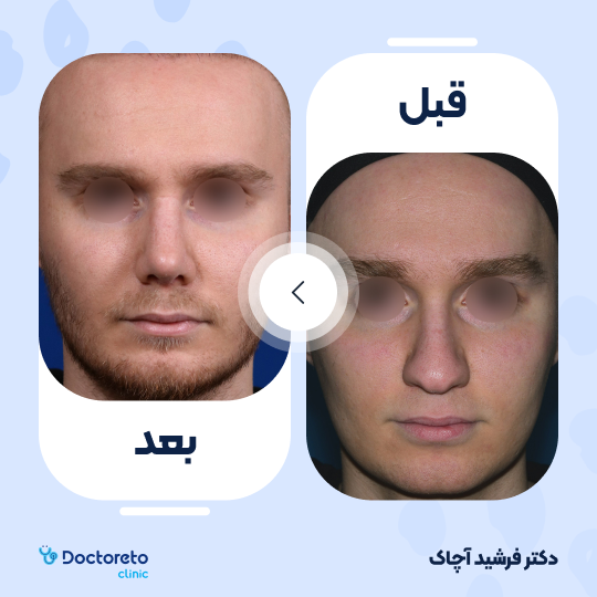 عمل جراحی ترمیمی زیبایی بینی (رینوپلاستی)