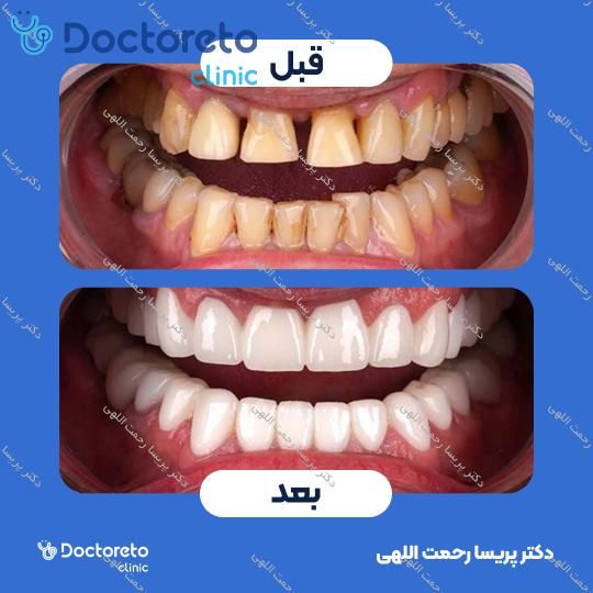 ونیر کامپوزیت (هر واحد)