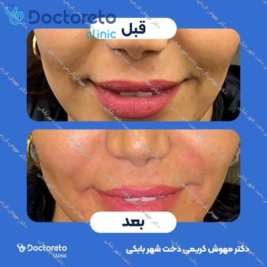تزریق ژل لب