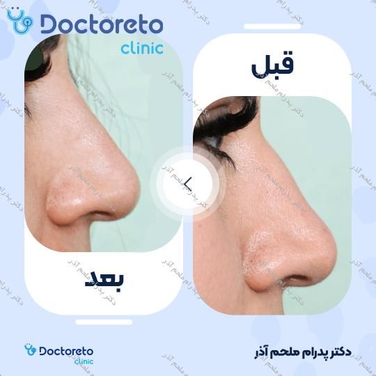 تزریق ژل بینی