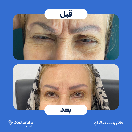 تزریق بوتاکس صورت (پیشانی، خط اخم، پنجه کلاغی)💉