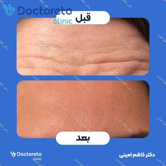 تزریق بوتاکس صورت (پیشانی، خط اخم، پنجه کلاغی)💉