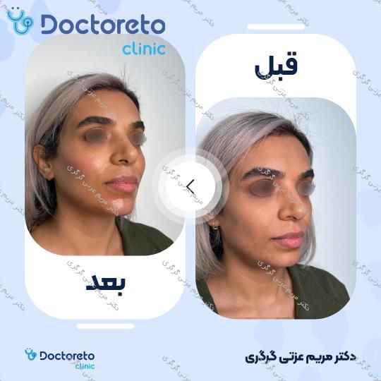 تزریق ژل چانه