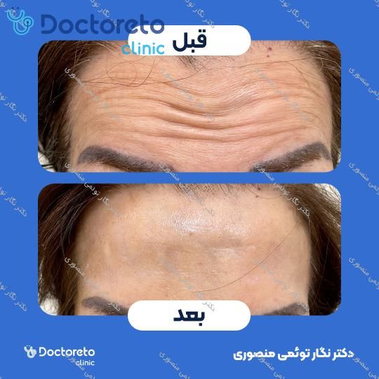 تزریق بوتاکس صورت (پیشانی، خط اخم، پنجه کلاغی)💉