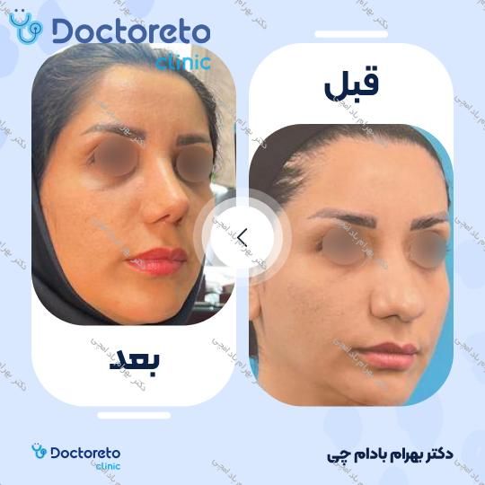 عمل زیبایی بینی گوشتی (رینوپلاستی)