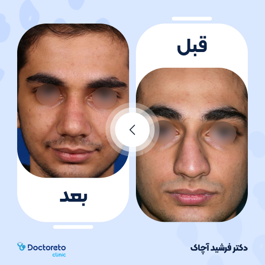 عمل زیبایی بینی گوشتی (رینوپلاستی)