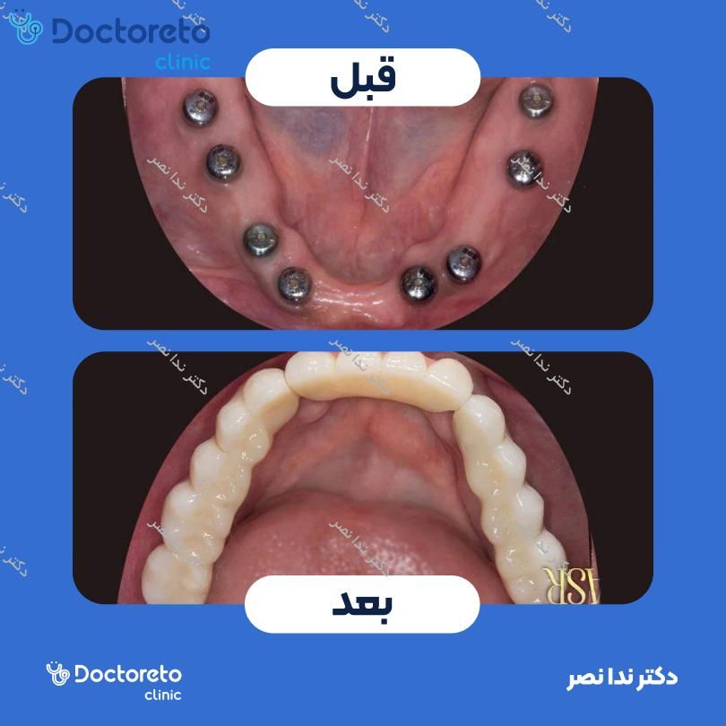 ایمپلنت دندان با روکش (هر واحد)