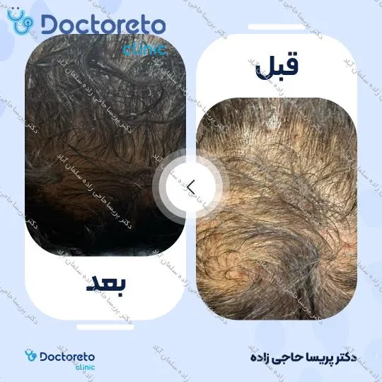 مزوتراپی مو به همراه اگزوزوم تراپی (هر جلسه)