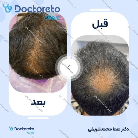 درمان ریزش موی سر با تزریق مزوتراپی (هرجلسه)