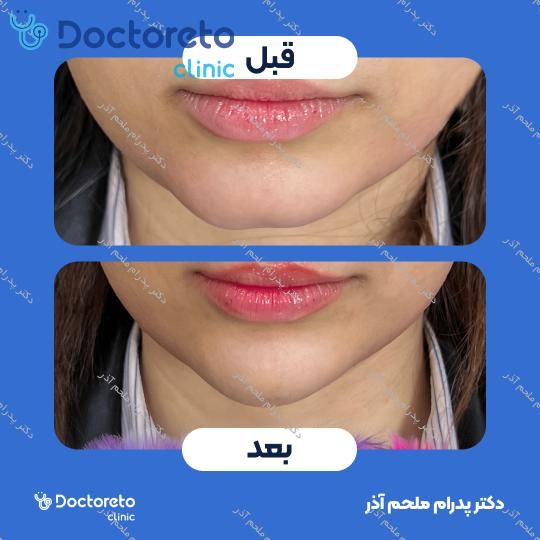 تزریق ژل چانه