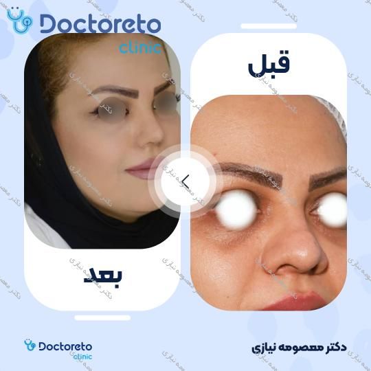 عمل جراحی مجدد زیبایی بینی (رینوپلاستی)