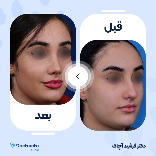 عمل جراحی زیبایی بینی (رینوپلاستی)