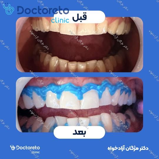 بلیچینگ دندان (سفید کردن دندان)