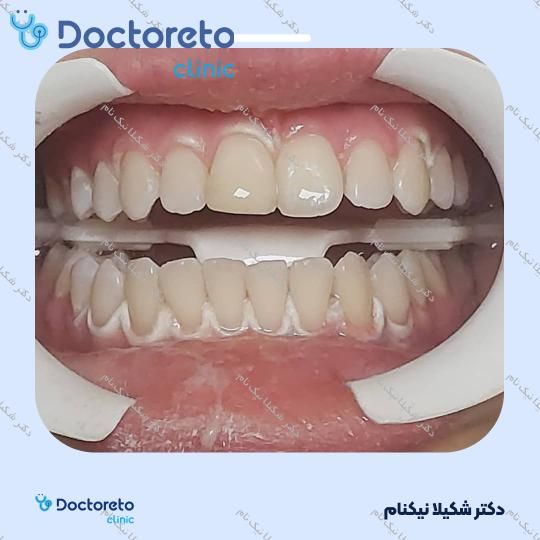 بلیچینگ دندان (سفید کردن دندان)