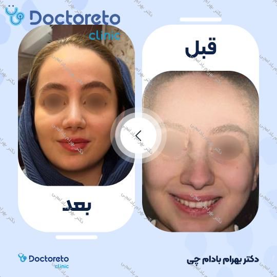 عمل زیبایی بینی گوشتی (رینوپلاستی)