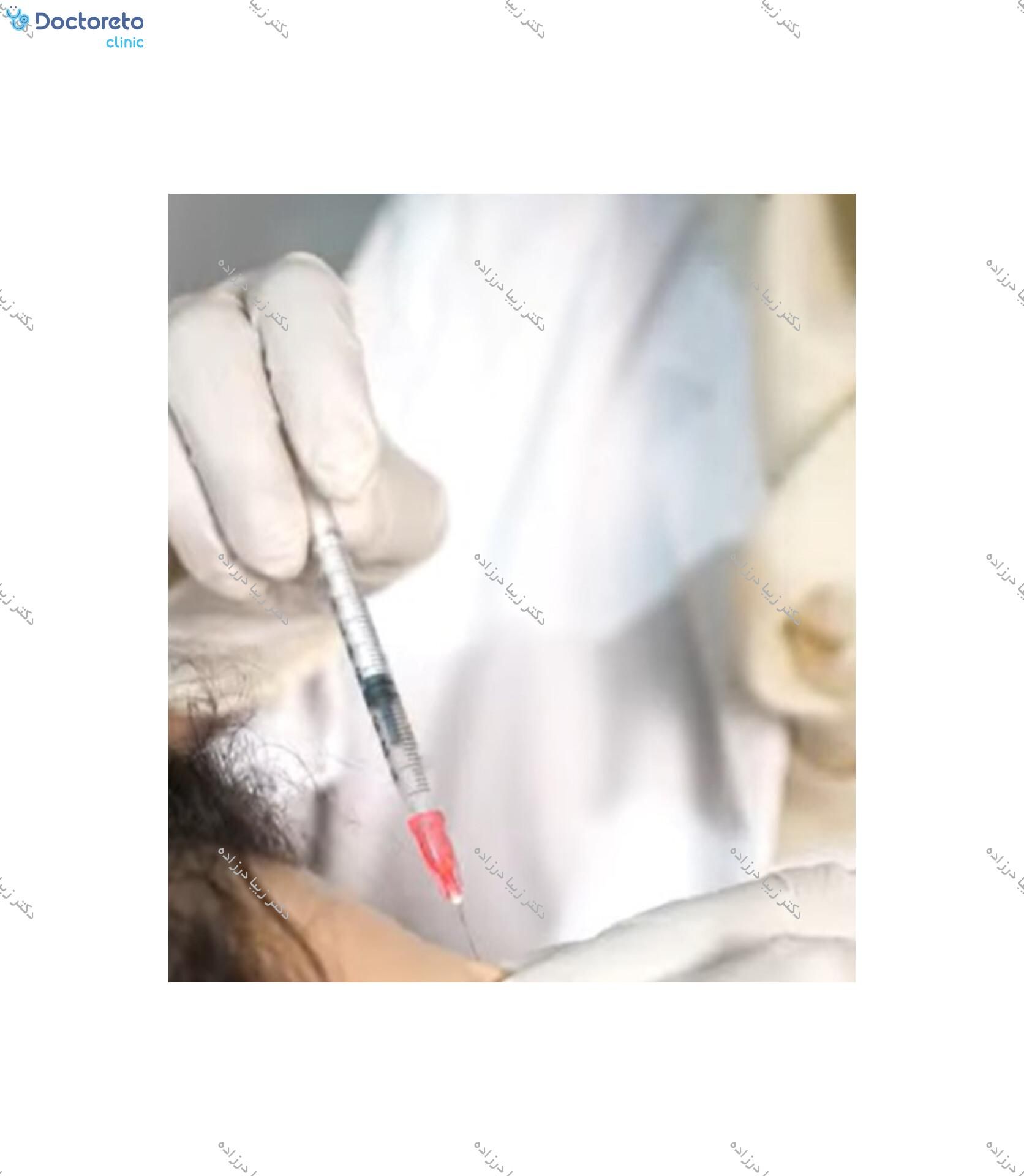 تزریق بوتاکس صورت (پیشانی، خط اخم، پنجه کلاغی)💉