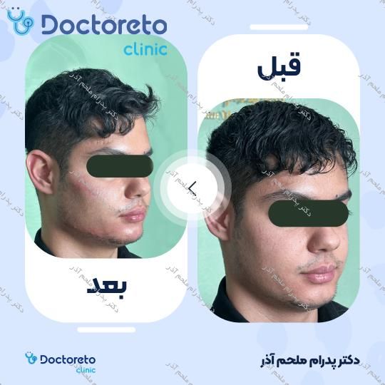 تزریق ژل زاویه فک