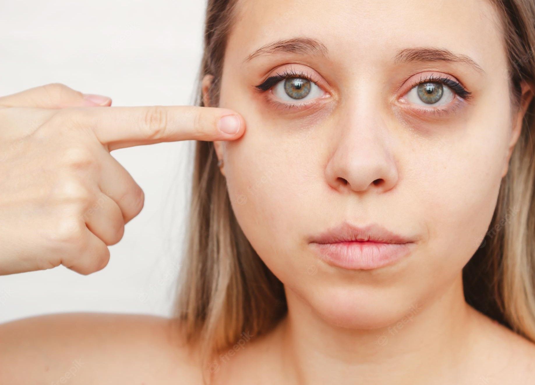 تزریق ژل زیرچشم