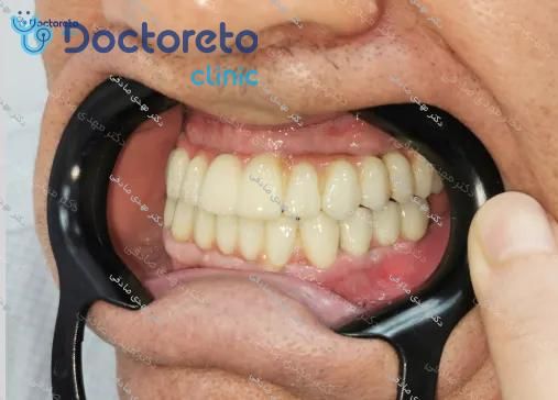 ایمپلنت دندان بدون روکش (هر واحد)