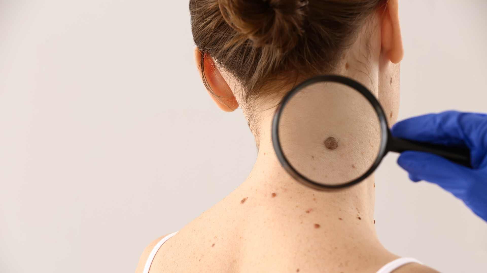 برداشتن خال کوچک با پلاسماجت