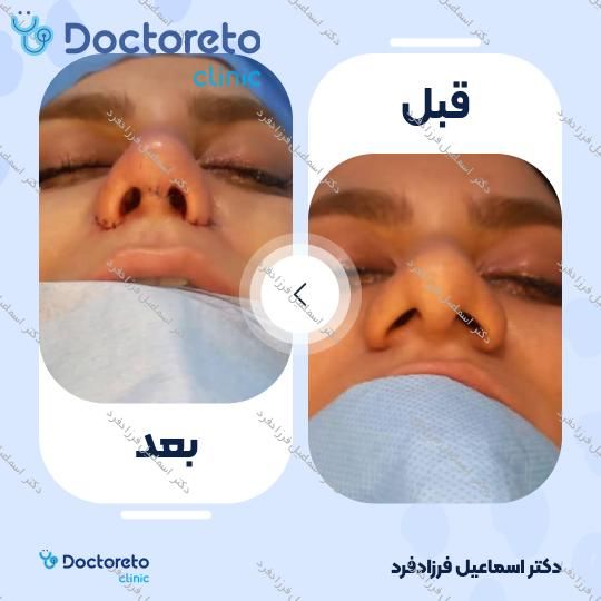 عمل زیبایی بینی (رینوپلاستی)