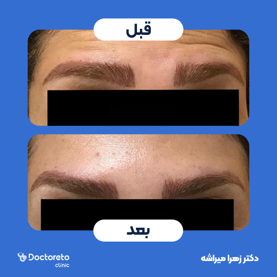 تزریق بوتاکس صورت (پیشانی، خط اخم، پنجه کلاغی)💉